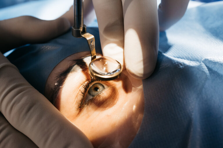 Image illustrant la préparation à une opération de l'œil pour une chirurgie de la cataracte, mettant en avant les étapes avant l'intervention.